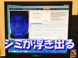 男性 シミ