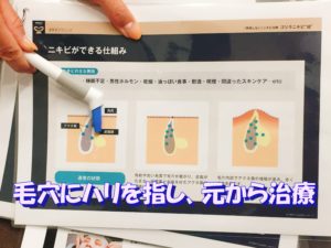 男 ニキビ治療